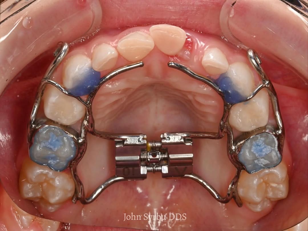 Post 6 by John Syrbu DDS on Instagram (carousel)