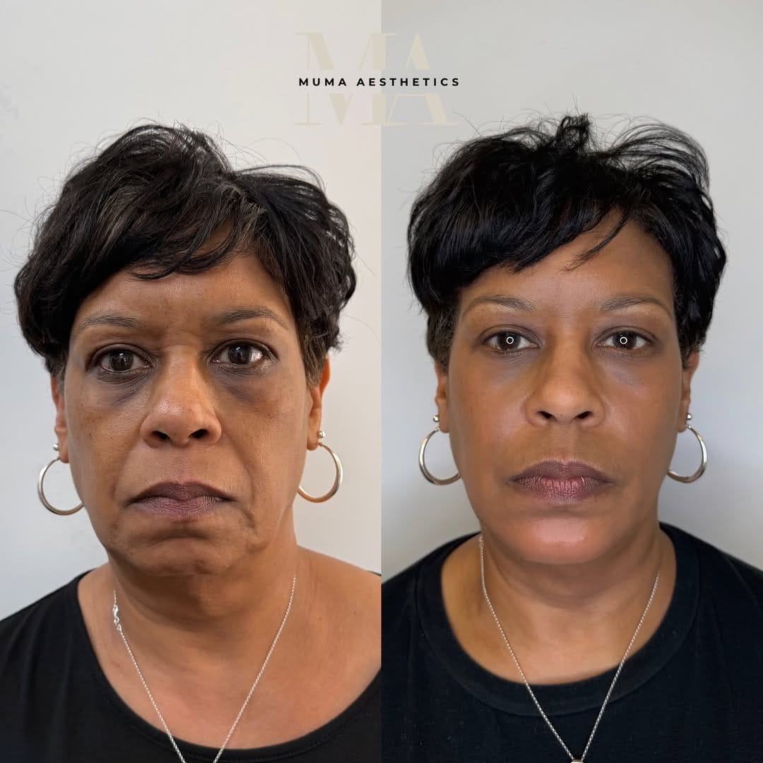 Post 9 by Muma Aesthetics | DMV Facial Balancing, Botox, Filler & More on Instagram (carousel)