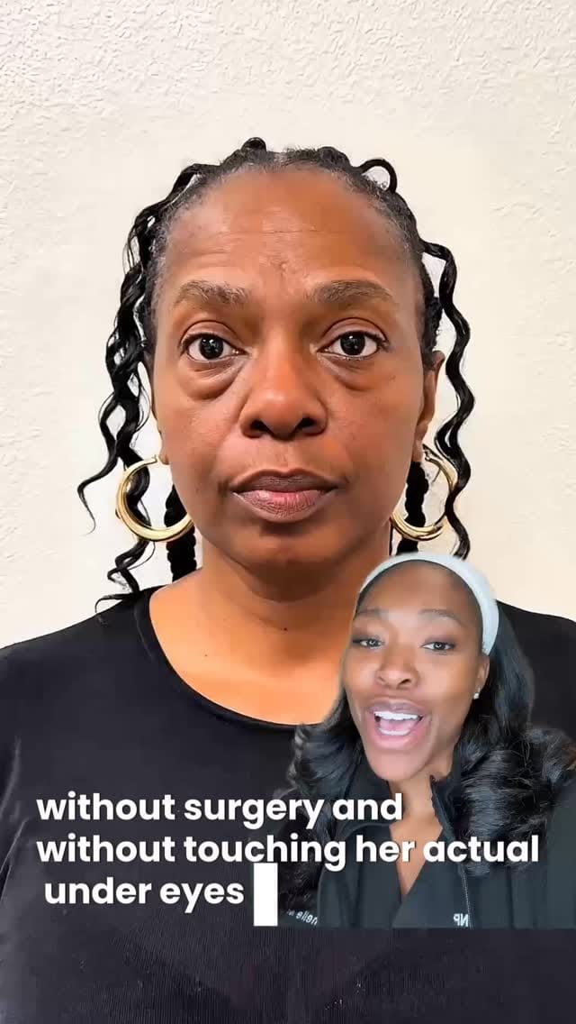 Post 10 by Muma Aesthetics | DMV Facial Balancing, Botox, Filler & More on Instagram (video)