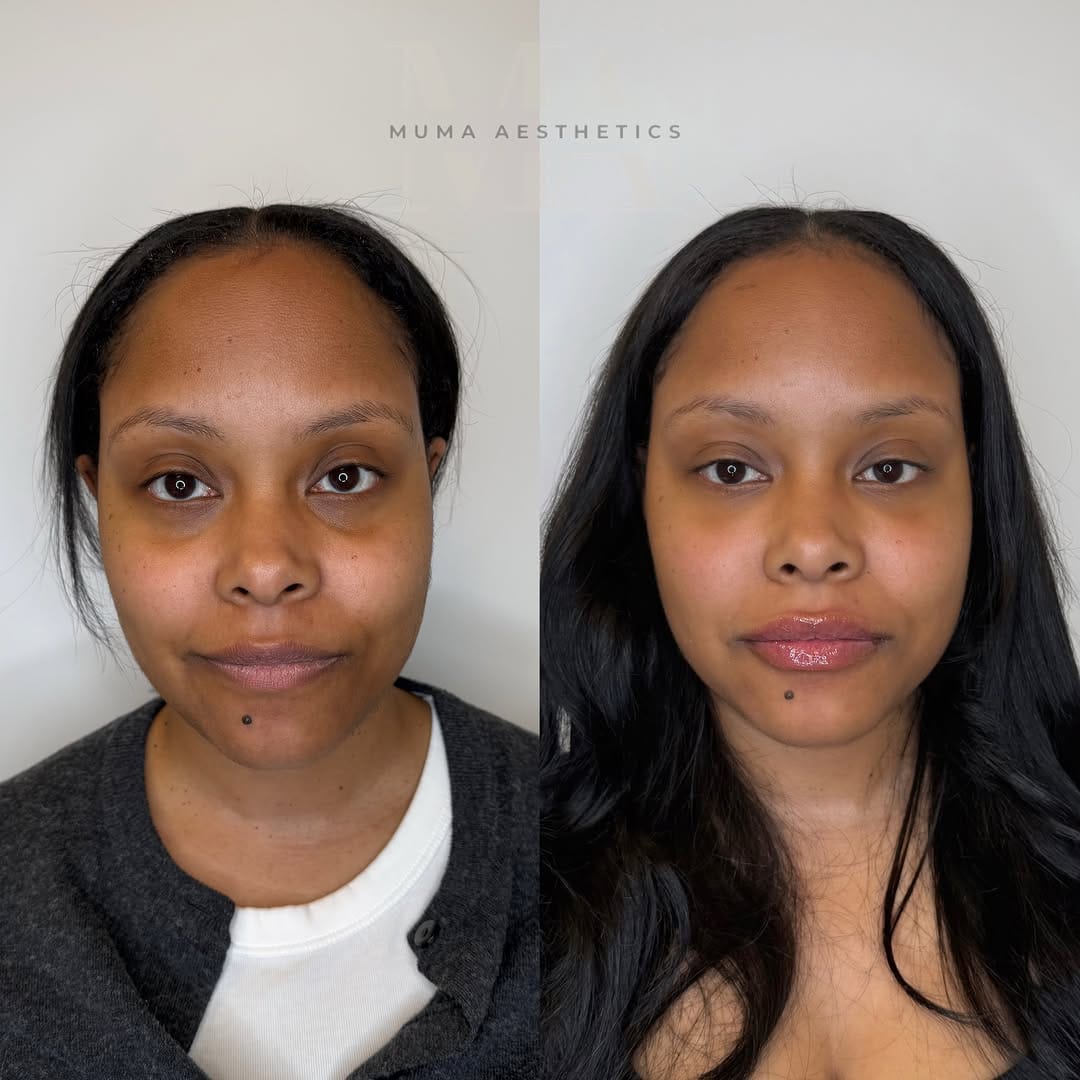Post 1 by Muma Aesthetics | DMV Facial Balancing, Botox, Filler & More on Instagram (carousel)