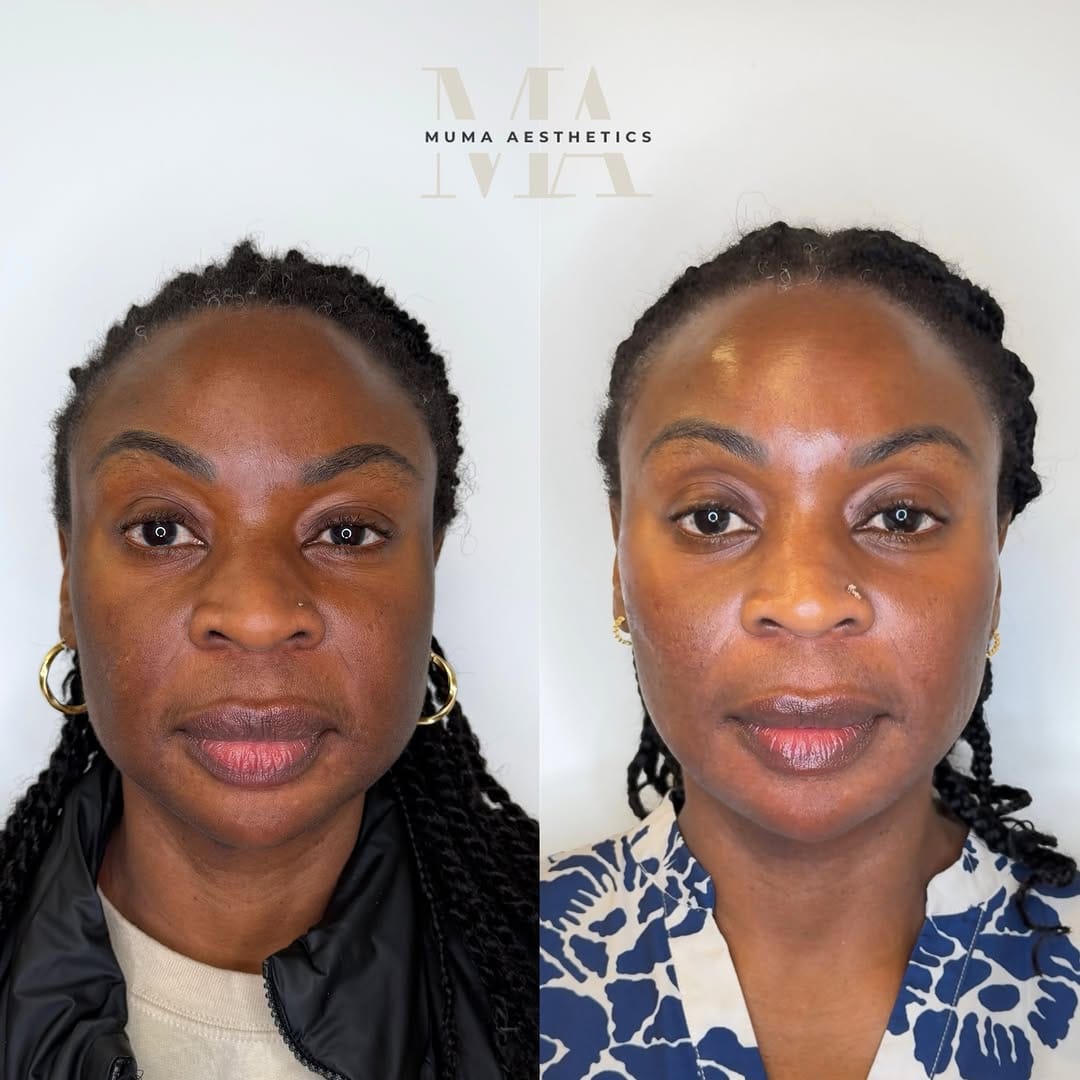 Post 3 by Muma Aesthetics | DMV Facial Balancing, Botox, Filler & More on Instagram (carousel)