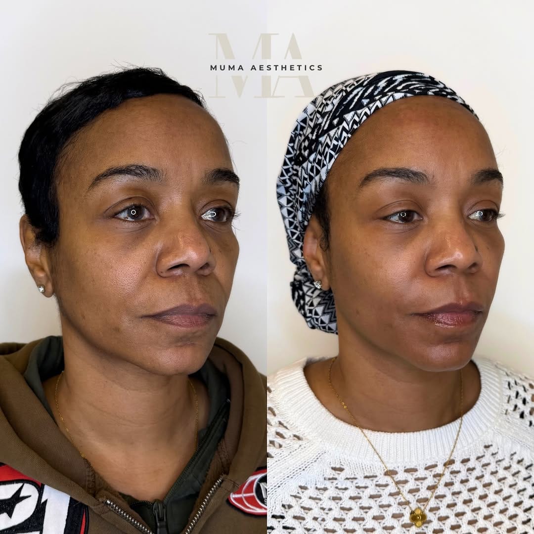 Post 6 by Muma Aesthetics | DMV Facial Balancing, Botox, Filler & More on Instagram (carousel)