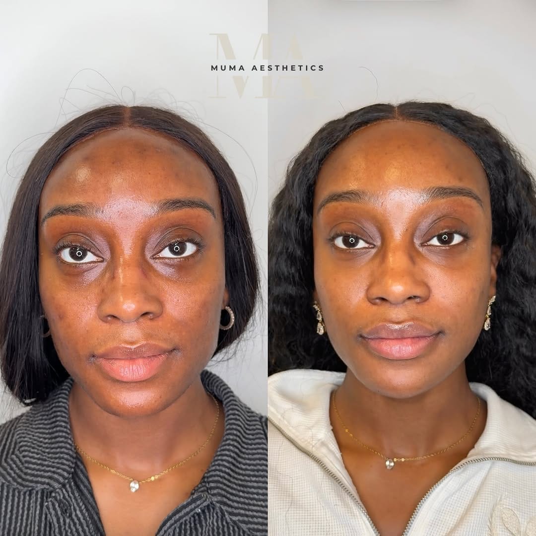 Post 5 by Muma Aesthetics | DMV Facial Balancing, Botox, Filler & More on Instagram (carousel)