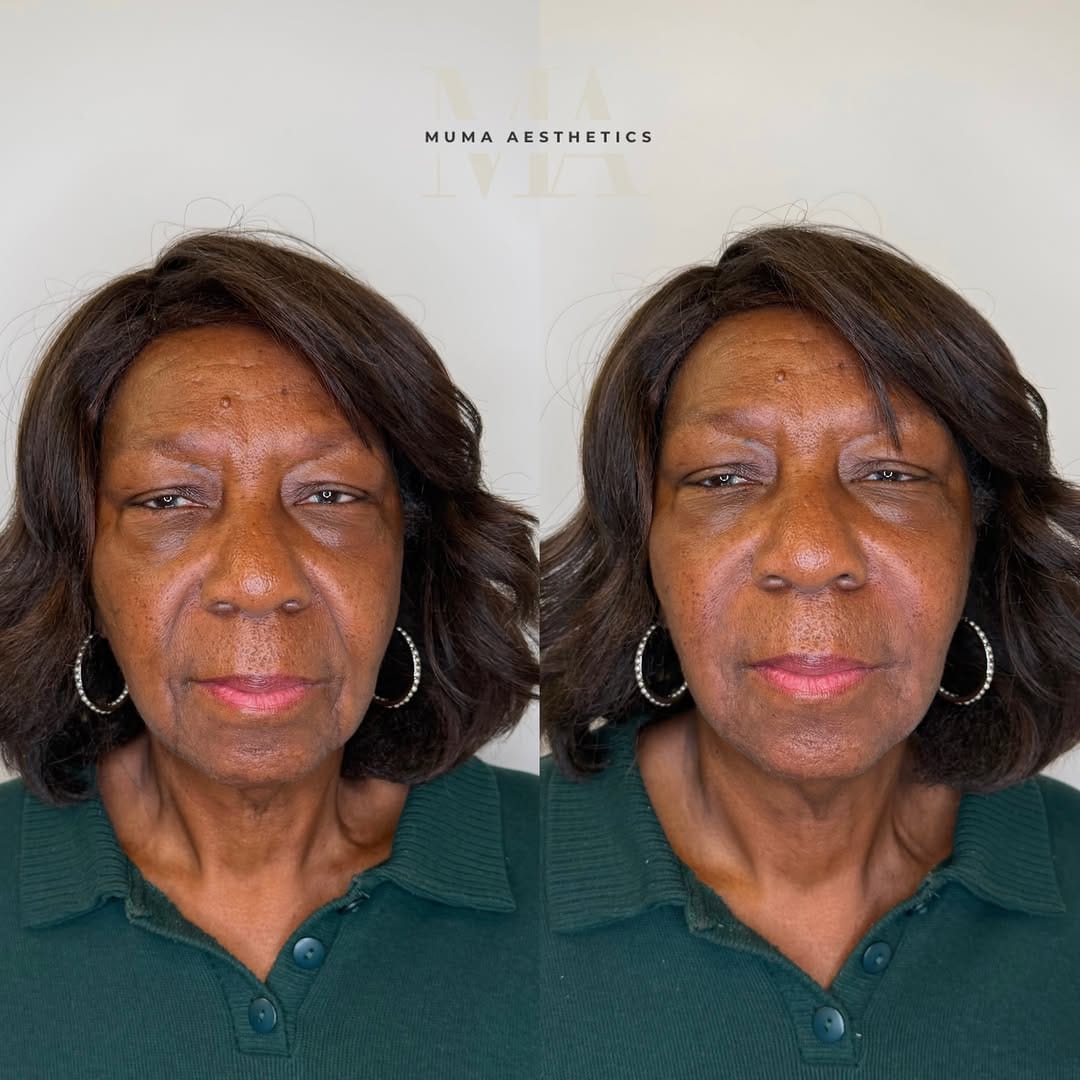Post 2 by Muma Aesthetics | DMV Facial Balancing, Botox, Filler & More on Instagram (carousel)