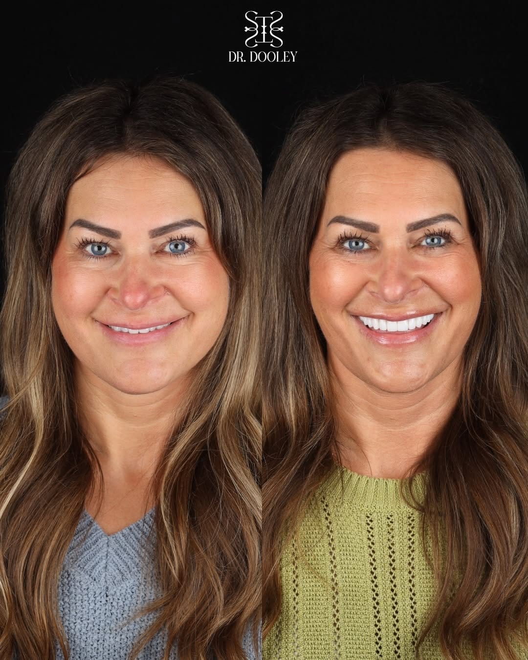 Post 5 by Mackenzi Dooley DDS on Instagram (carousel)
