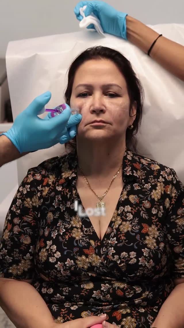 Post 3 by DermaMedicalUSA | Injector Training💉 on Instagram (video)