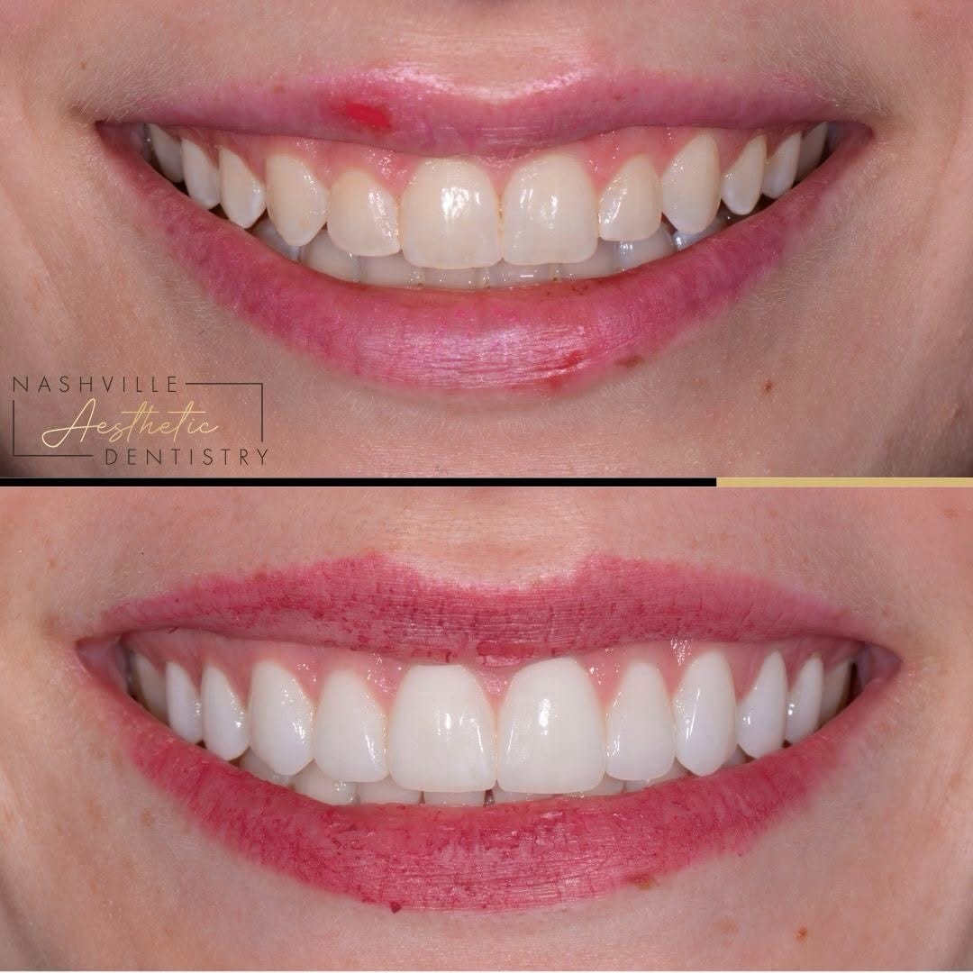 Post 2 by Nashville Aesthetic Dentistry on Instagram (carousel)