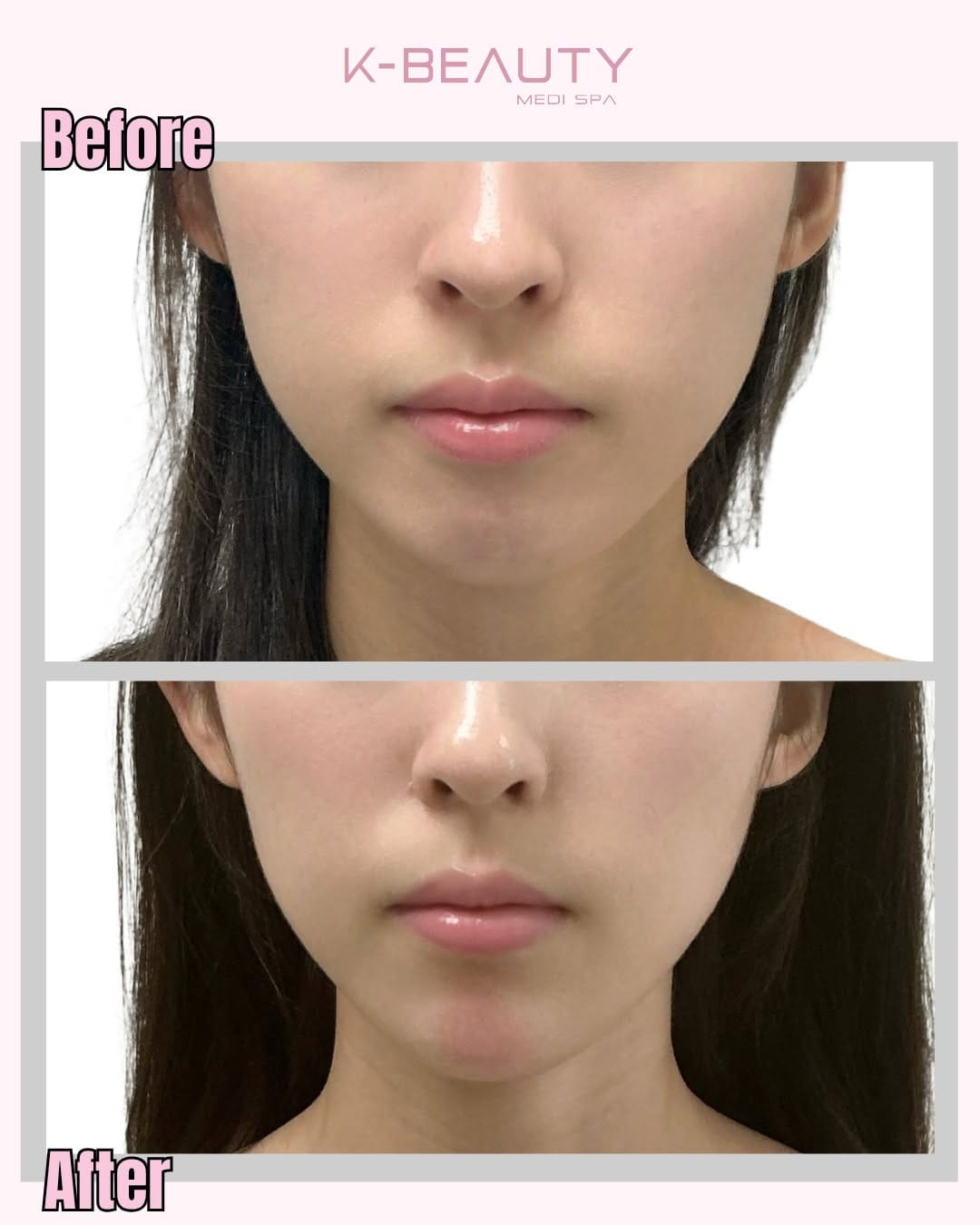 Post 8 by K-Beauty Medi Spa on Instagram (carousel)