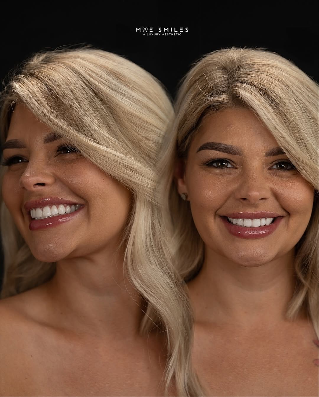 Post 8 by Dr. Mohamed Hassan | Houston Cosmetic Dentist | Veneers Expert on Instagram (carousel)