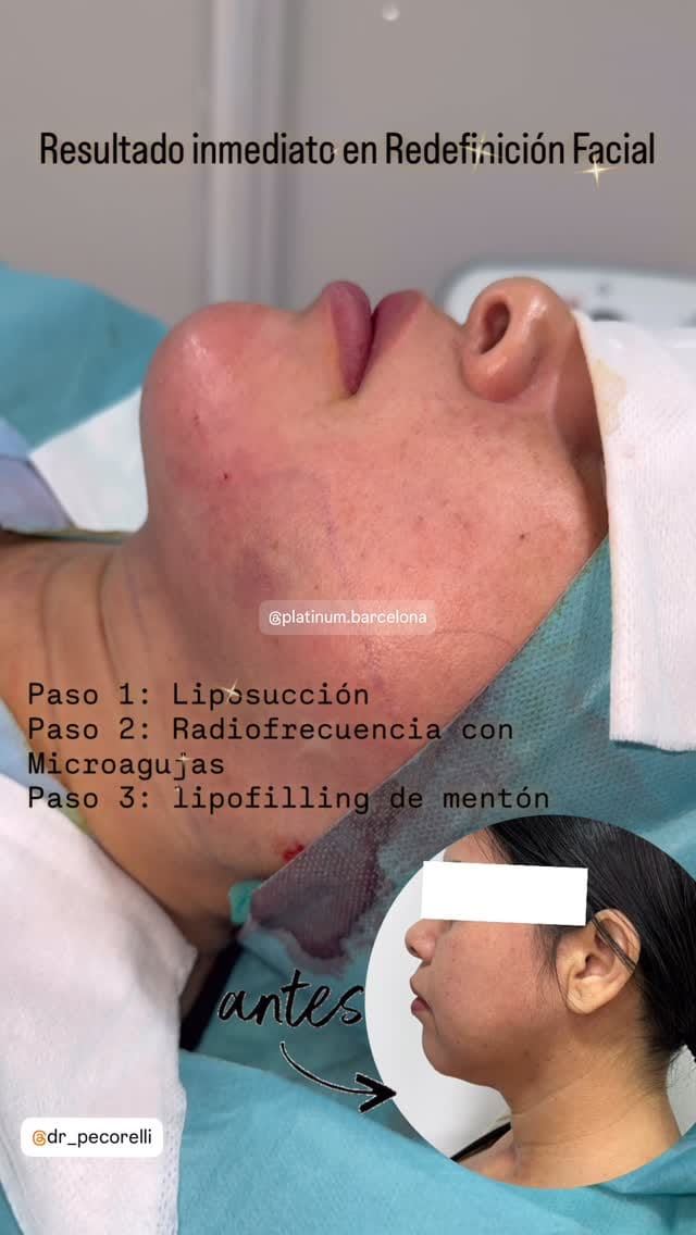 Post 8 by Dr. Angel Pecorelli, MD, IBCS on Instagram (video)
