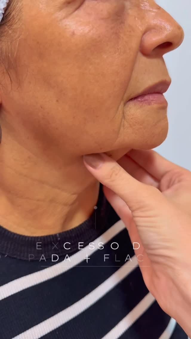 Post 7 by Dra Gabriela Melo - Harmonização facial on Instagram (video)