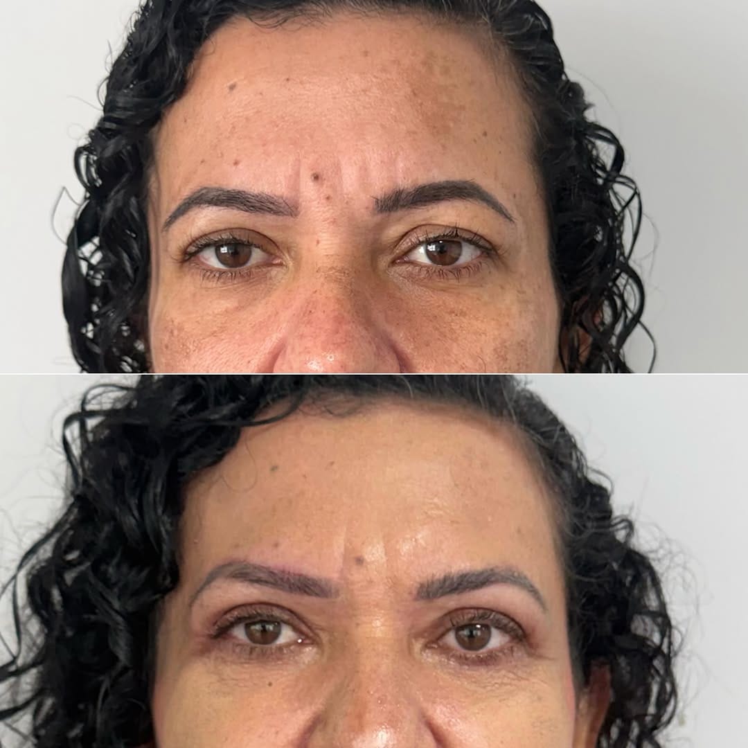 Post 5 by Dra Gabriela Melo - Harmonização facial on Instagram (carousel)