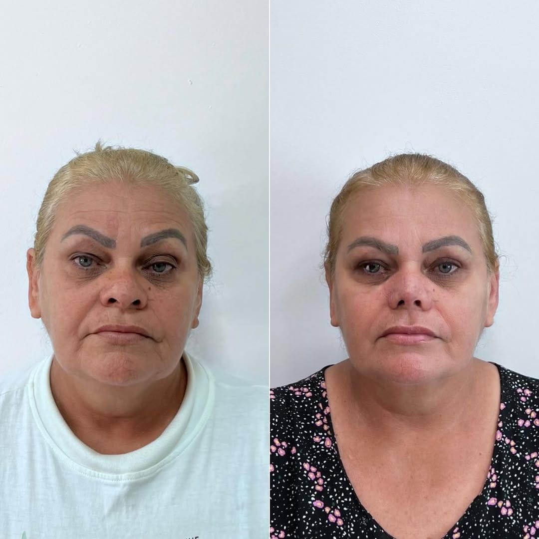 Post 1 by Dra Gabriela Melo - Harmonização facial on Instagram (carousel)