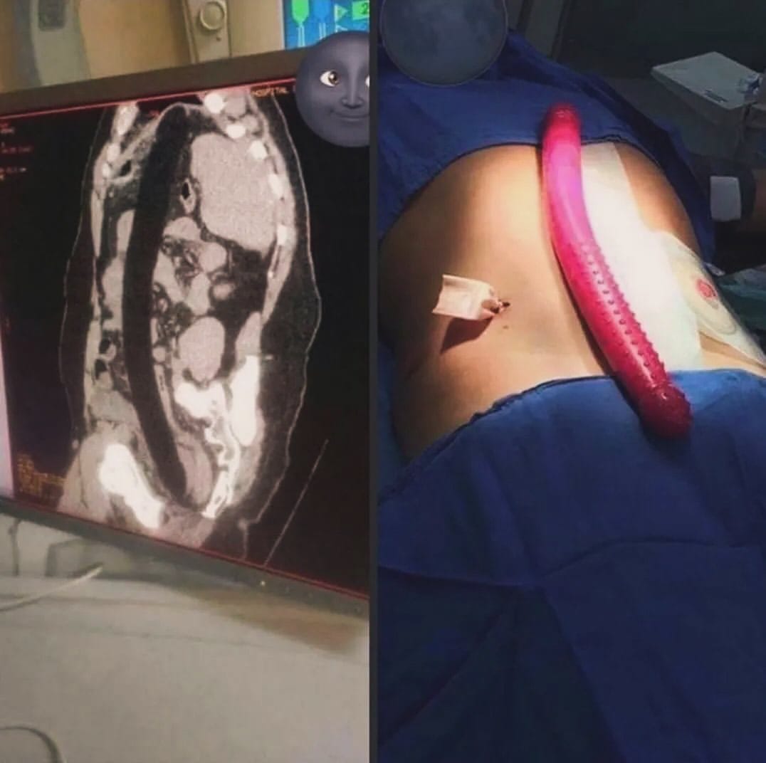 Post 3 by 🔞 CIRUGÍAS/CIRUJANOS/SURGERY on Instagram (image)