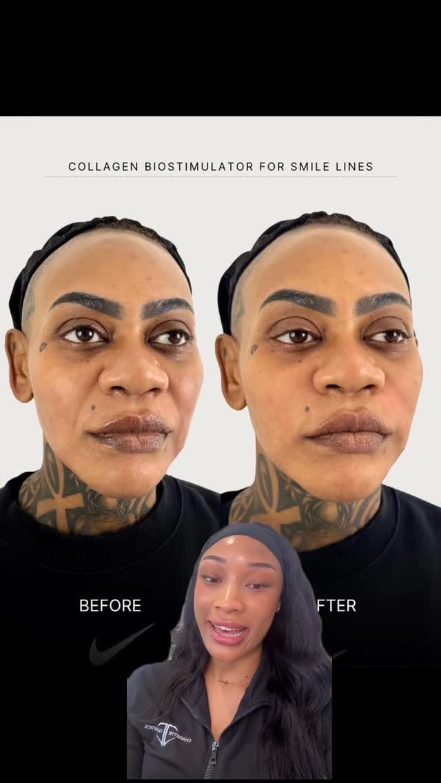 Post 3 by 📍DALLAS NURSE INJECTOR-ALEXIS MILNER: BOTOX•FILLER•LIQUID BBL✨ on Instagram (video)