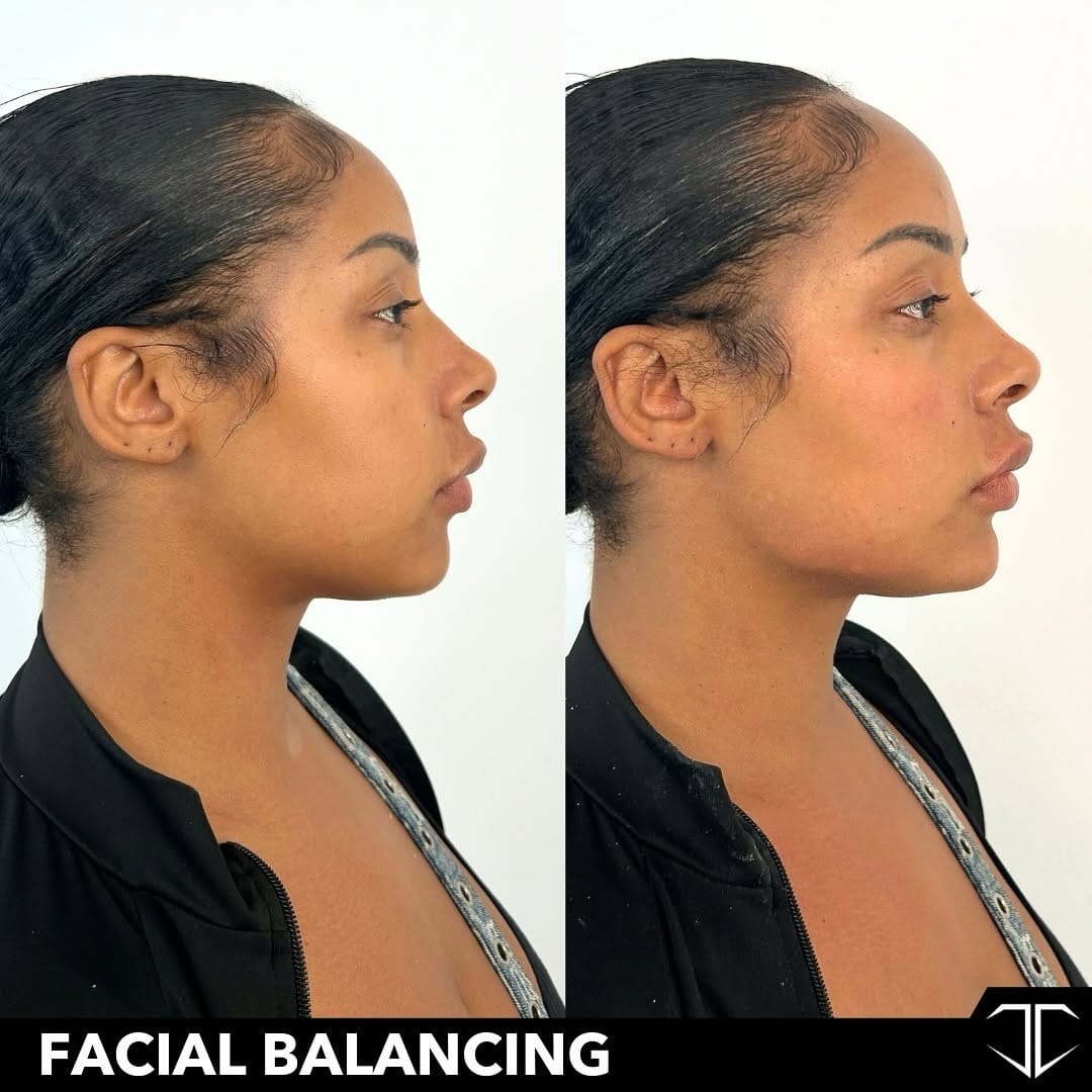 Post 10 by 📍DALLAS NURSE INJECTOR-ALEXIS MILNER: BOTOX•FILLER•LIQUID BBL✨ on Instagram (carousel)
