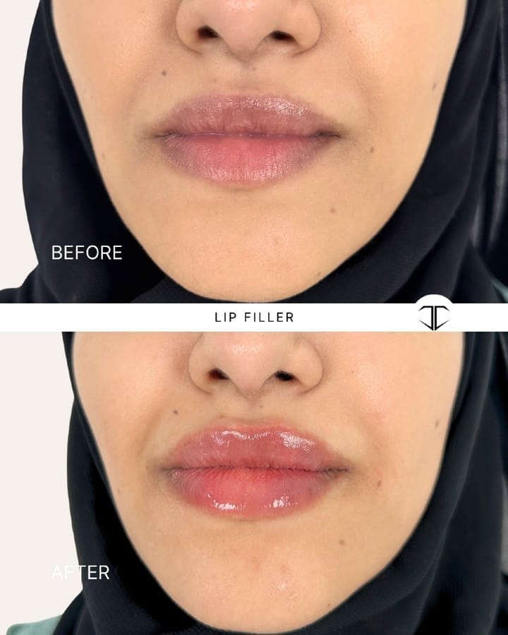 Post 1 by 📍DALLAS NURSE INJECTOR-ALEXIS MILNER: BOTOX•FILLER•LIQUID BBL✨ on Instagram (carousel)