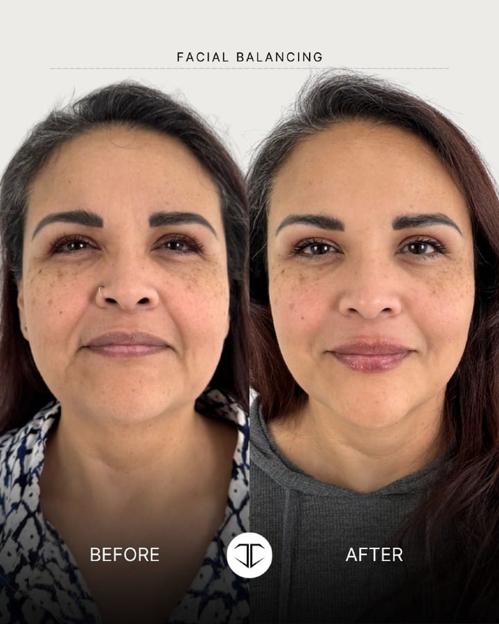 Post 7 by 📍DALLAS NURSE INJECTOR-ALEXIS MILNER: BOTOX•FILLER•LIQUID BBL✨ on Instagram (carousel)
