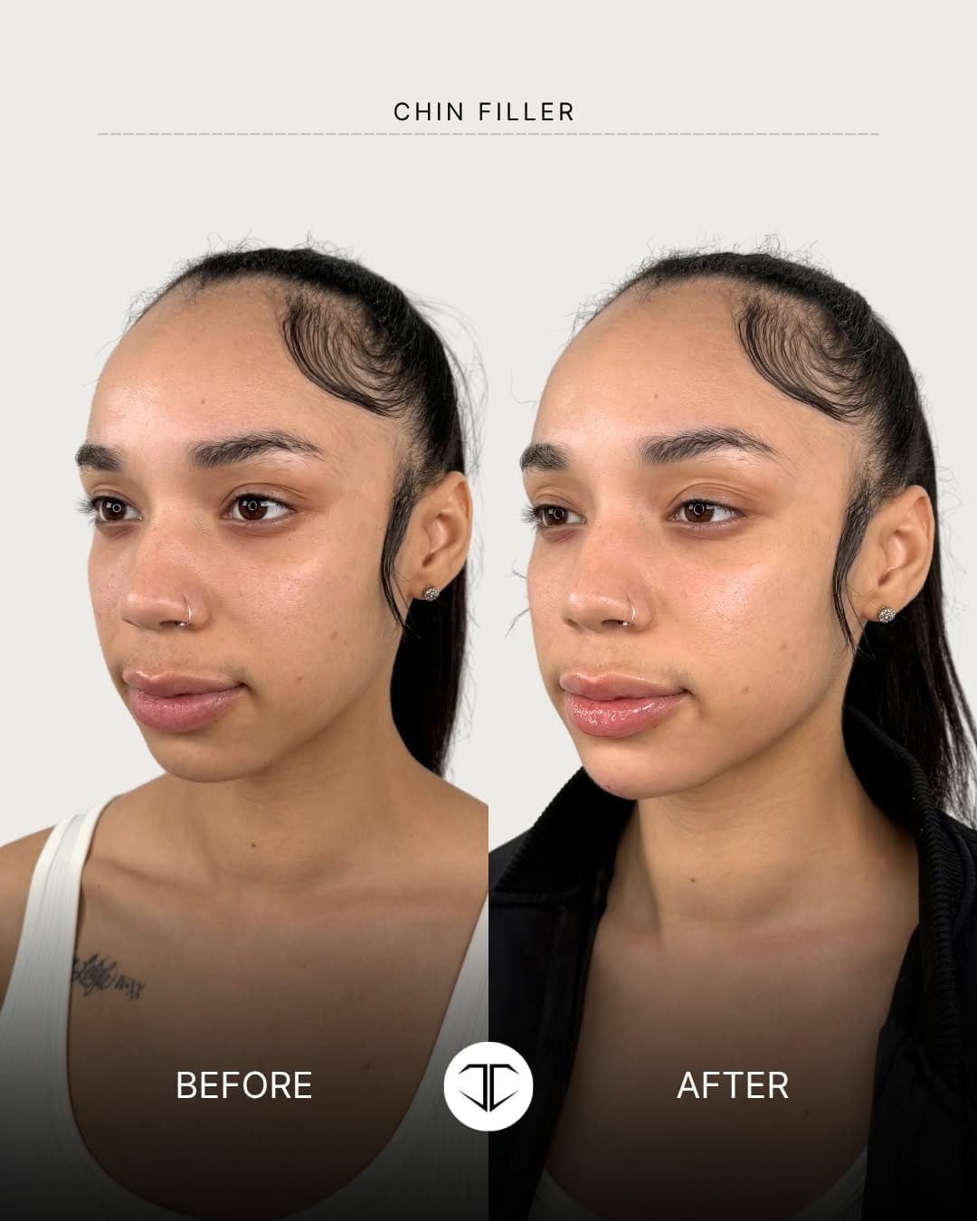 Post 6 by 📍DALLAS NURSE INJECTOR-ALEXIS MILNER: BOTOX•FILLER•LIQUID BBL✨ on Instagram (carousel)