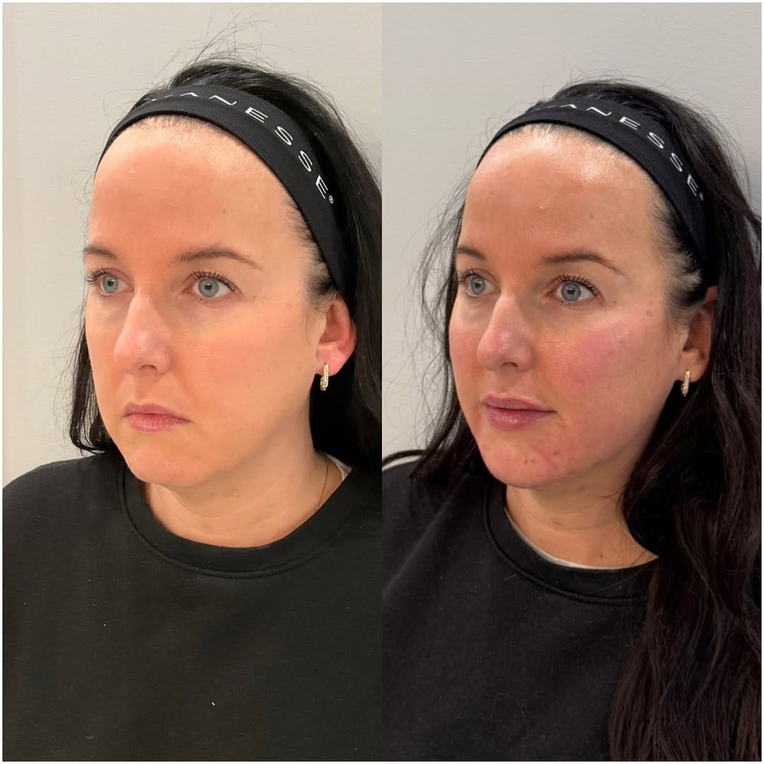 Post 8 by Kelowna’s Cosmetic Nurse Injector✨ on Instagram (carousel)