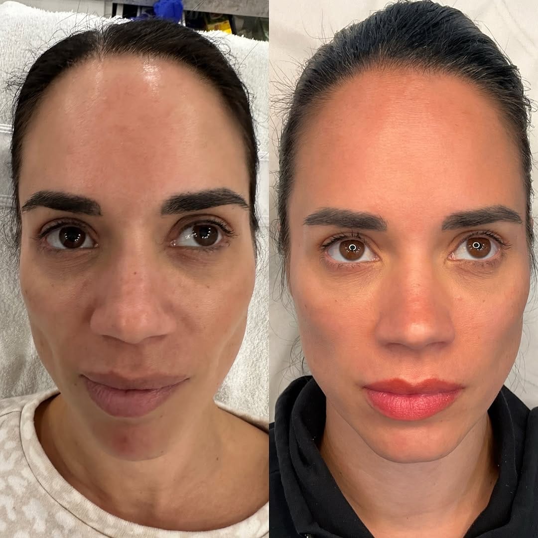 Post 10 by Kelowna’s Cosmetic Nurse Injector✨ on Instagram (carousel)
