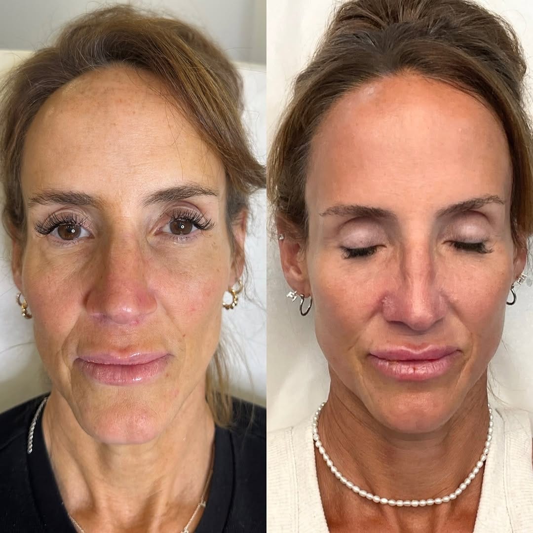Post 9 by Kelowna’s Cosmetic Nurse Injector✨ on Instagram (carousel)
