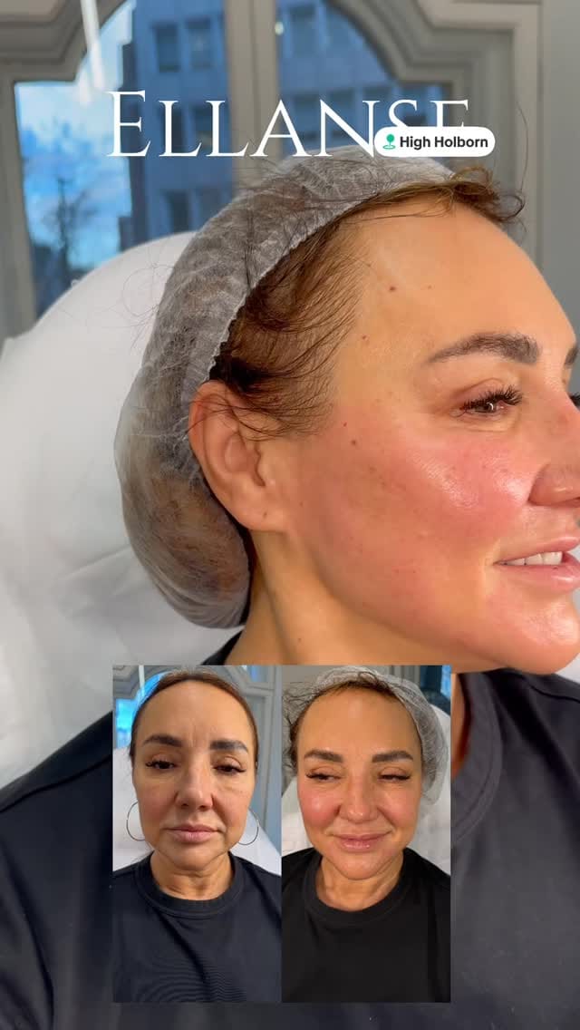 Post 8 by Aesthetic doctor/aesthetic clinic/botox/fillers/radiesse on Instagram (video)