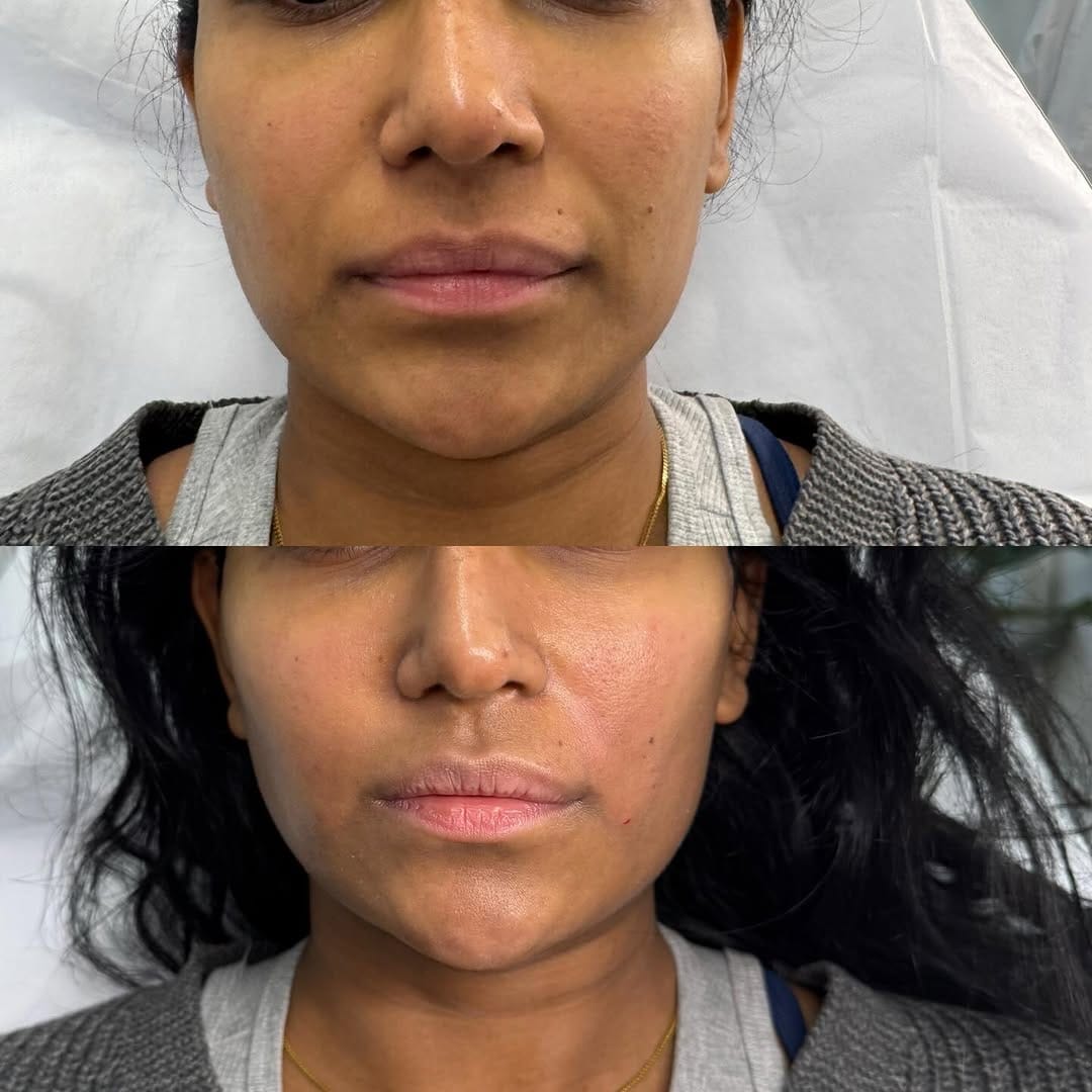 Post 7 by Aesthetic doctor/aesthetic clinic/botox/fillers/radiesse on Instagram (carousel)