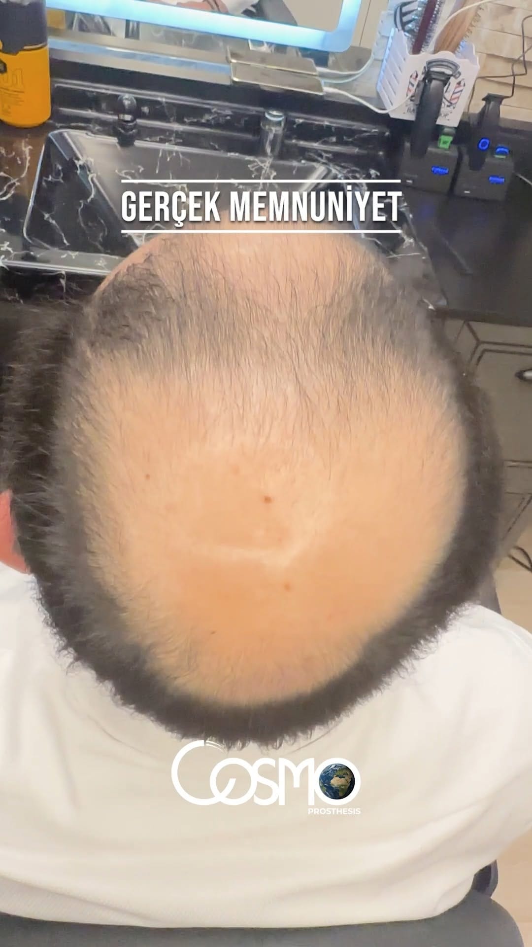 Post 2 by Cosmo Protez Saç Merkezi on Instagram (video)