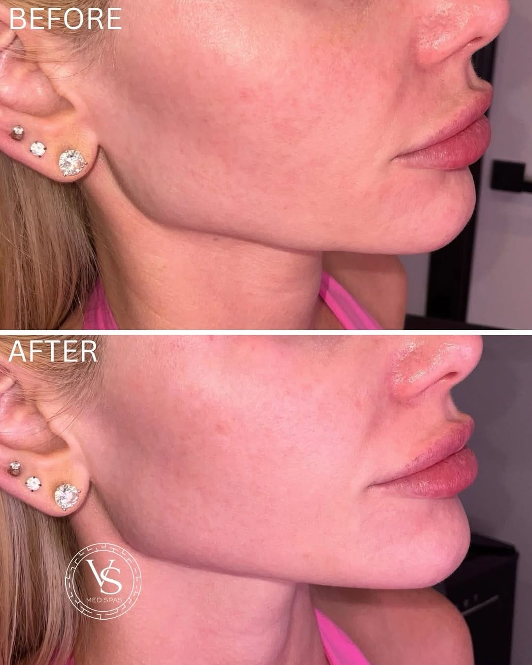 Post 4 by VS Med Spas on Instagram (image)