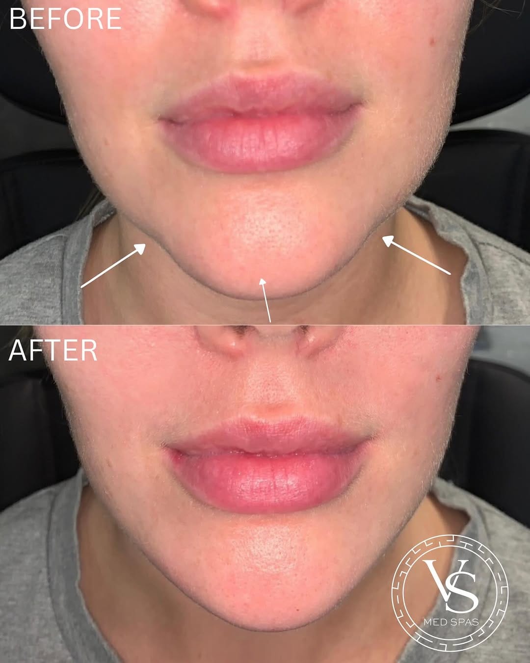 Post 8 by VS Med Spas on Instagram (carousel)