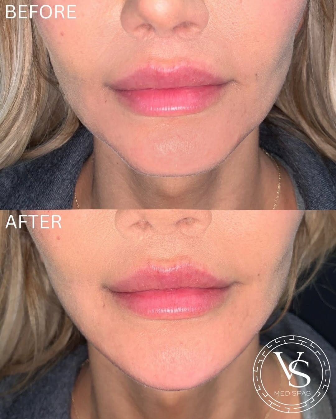 Post 9 by VS Med Spas on Instagram (carousel)