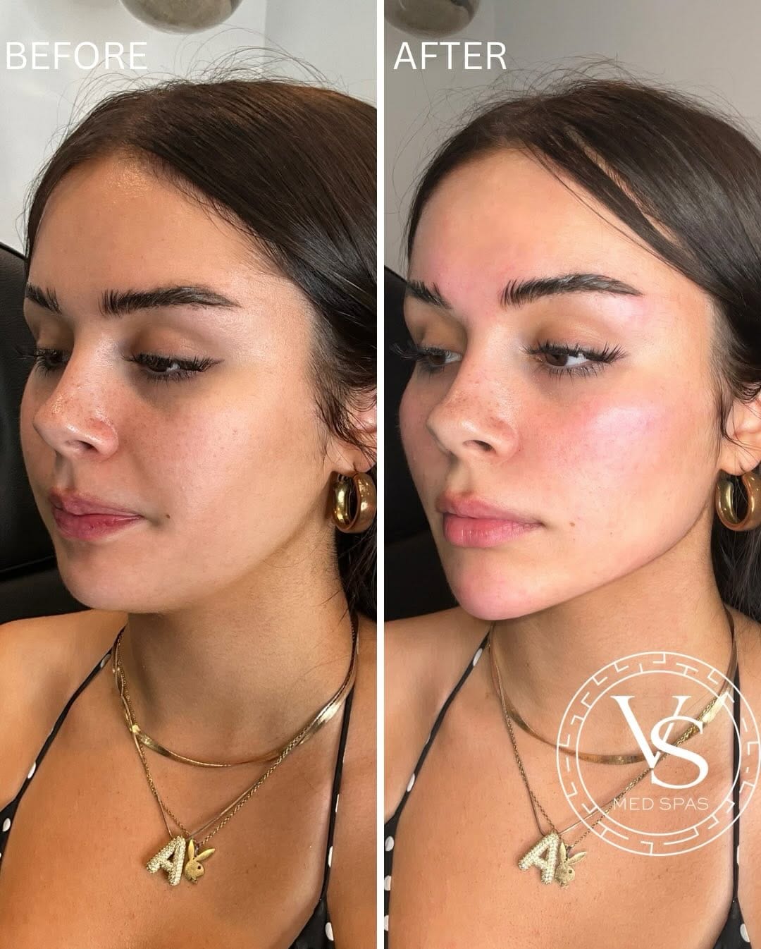Post 6 by VS Med Spas on Instagram (carousel)