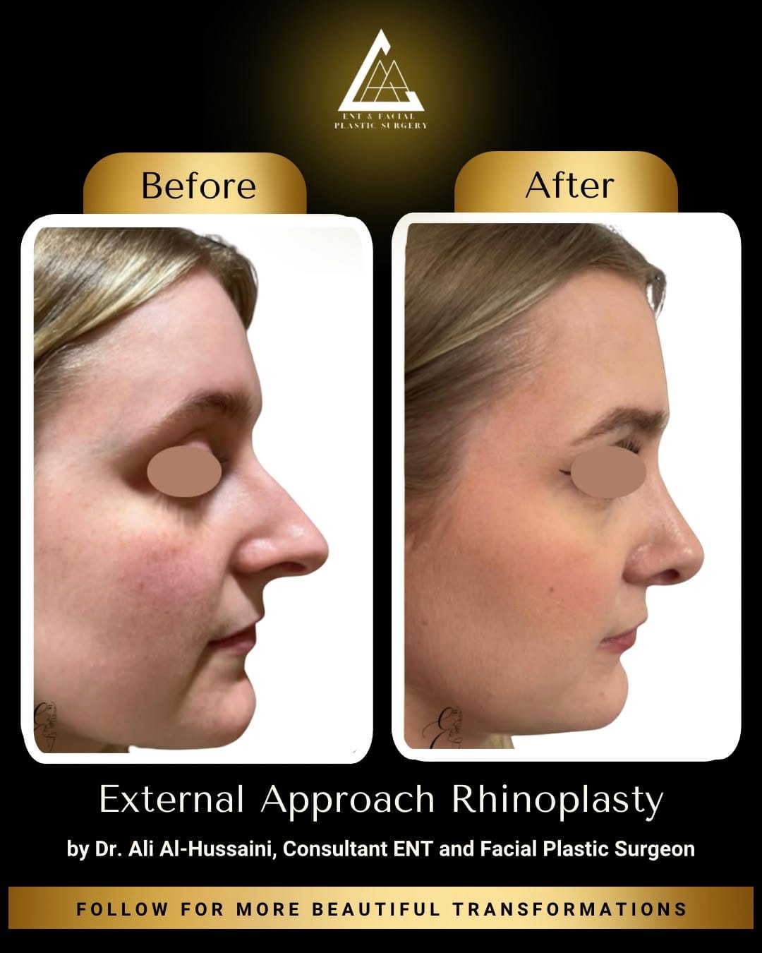Post 5 by Ali Al-Hussaini ENT & Facial Plastic Surgery on Instagram (image)