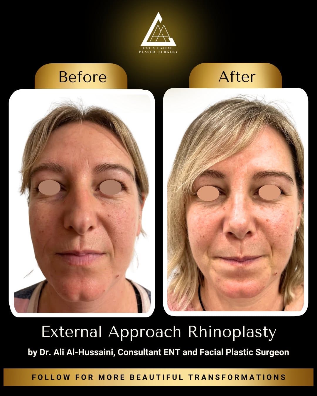 Post 3 by Ali Al-Hussaini ENT & Facial Plastic Surgery on Instagram (image)