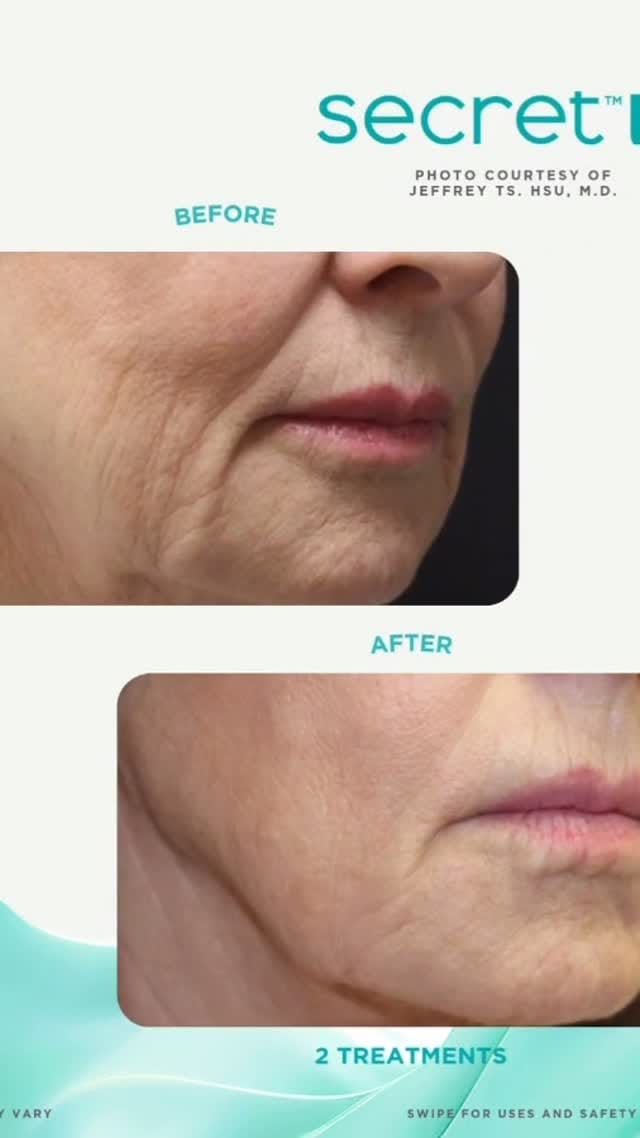 Post 10 by Elevate Medical & Aesthetic Clinic on Instagram (video)