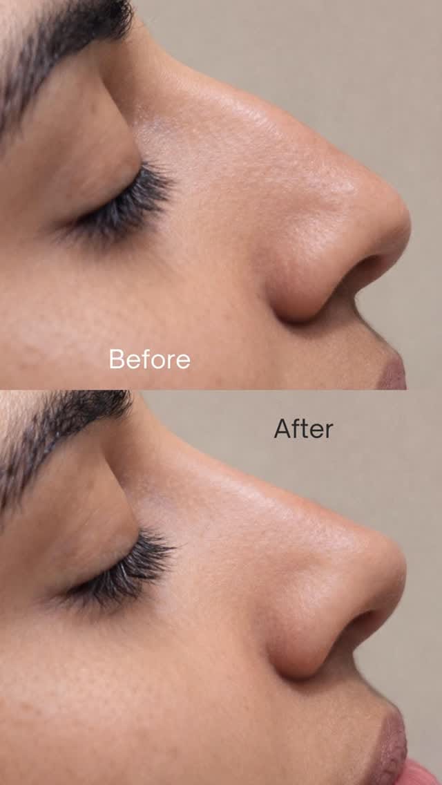 Post 4 by Dr. Malak Al Qaimari MD | Aesthetics & Peptides on Instagram (video)