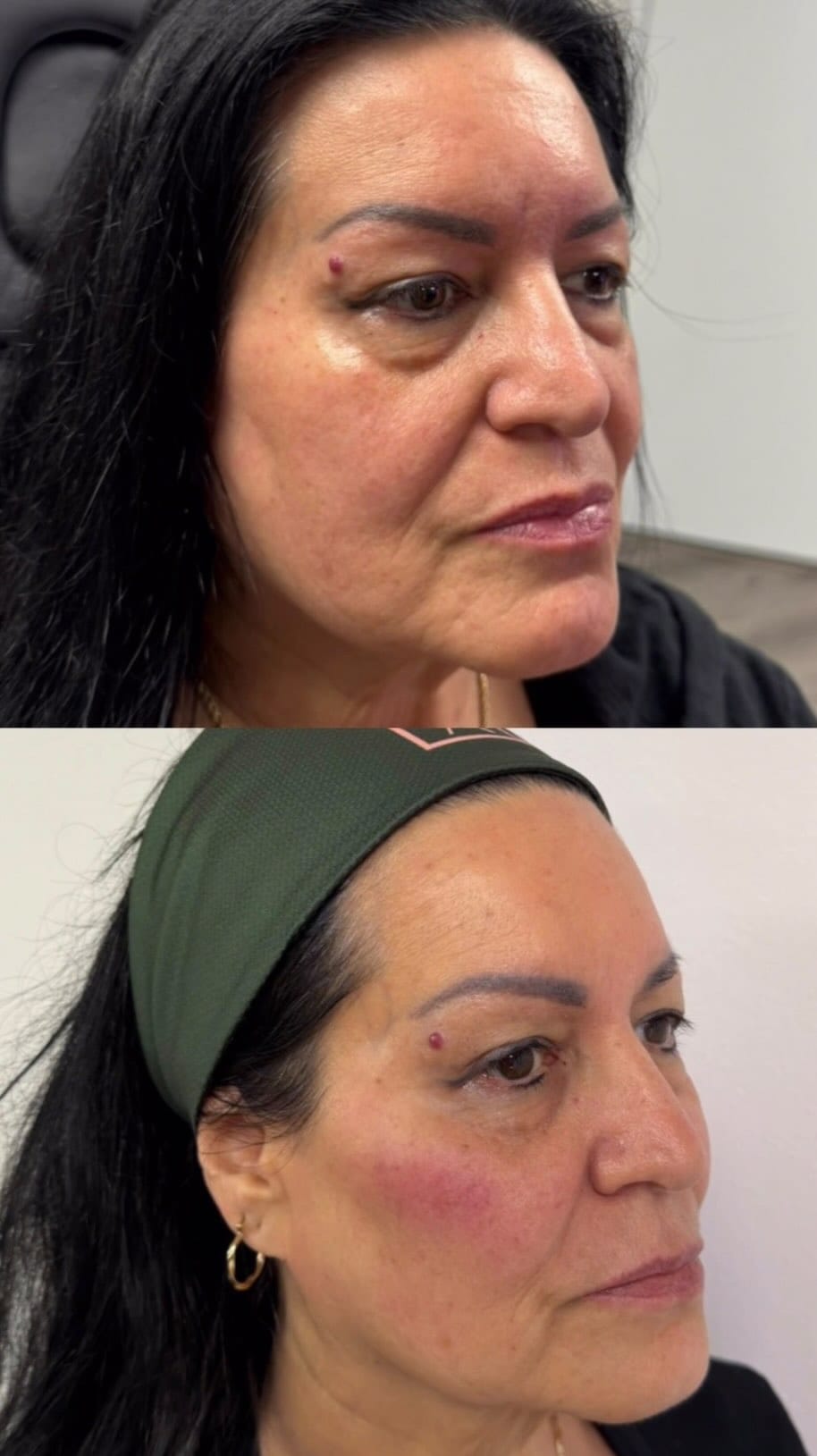 Post 2 by Manuel Guillen Robles - Nurse Practitioner Injector on Instagram (video)