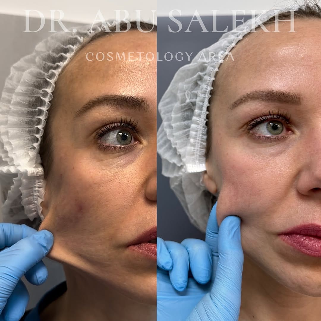 Post 10 by Dr.ABUSALEKH ДЕРМАТОЛОГ,КОСМЕТОЛОГ МОСКВА on Instagram (image)