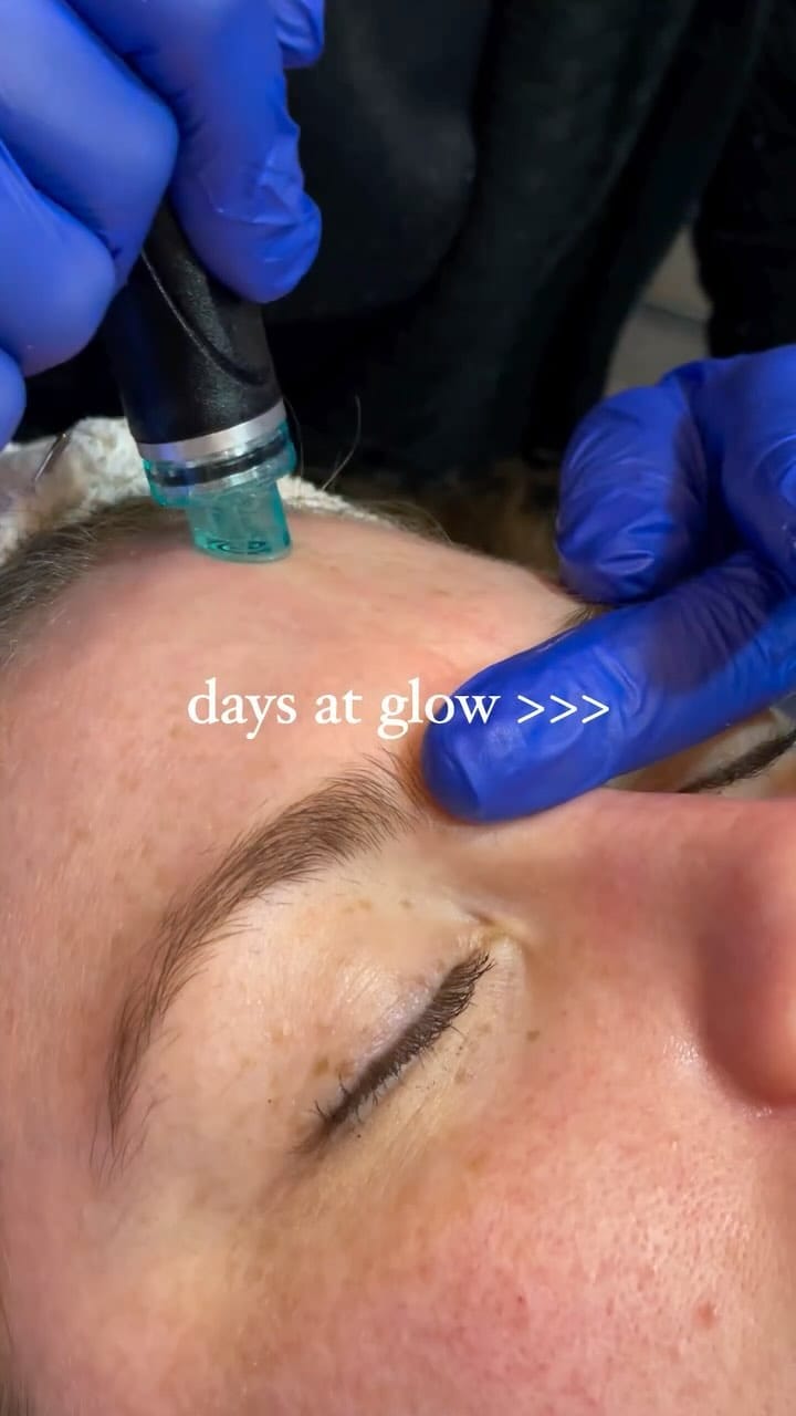 Post 10 by HydraFacial, BOTOX, Microneedling, Wax, Spraytan on Instagram (video)