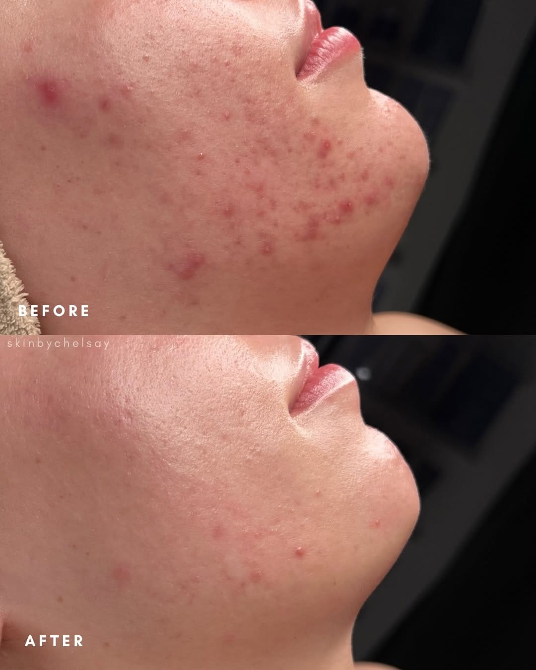 Post 6 by Chelsay Grojean | Kansas City                   Acne Specialist on Instagram (carousel)
