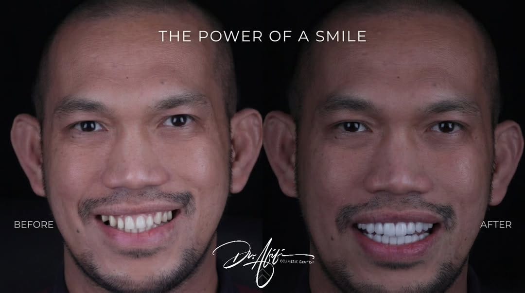 Post 5 by Dr.Mohamed Afifi | Cosmetic Dentist | DUBAI on Instagram (image)