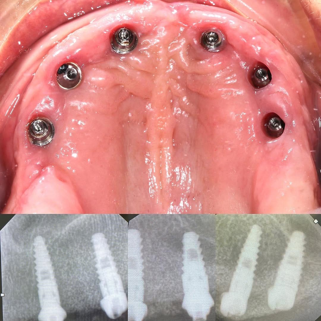 Post 6 by Oralsurgeries on Instagram (carousel)