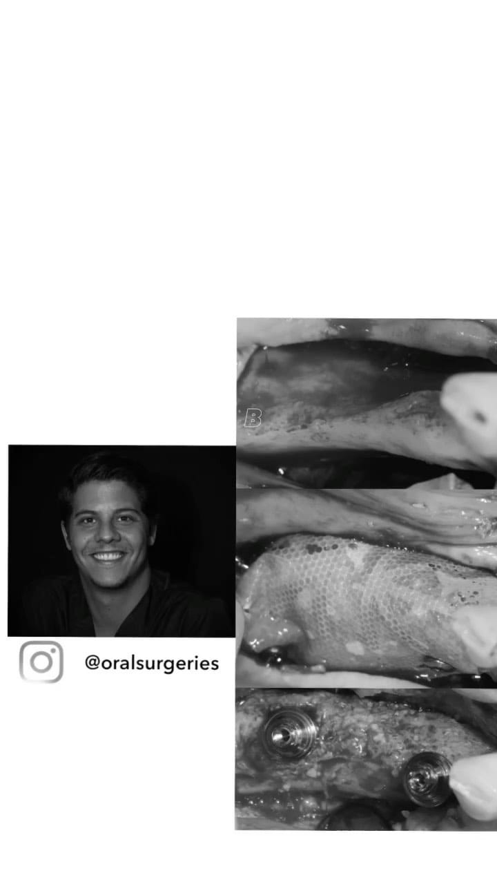 Post 8 by Oralsurgeries on Instagram (video)