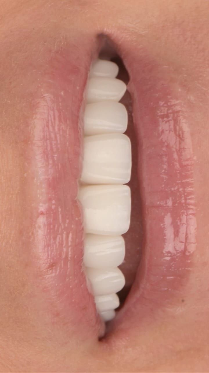 Post 1 by Jake Bateman FAGD | Nashville Aesthetic Dentist on Instagram (video)
