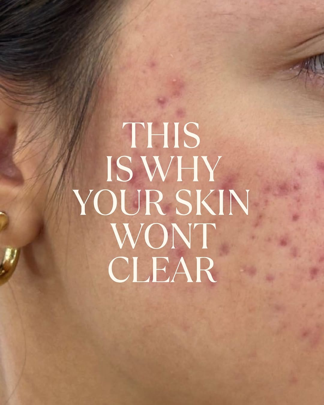 Post 9 by Clover Skin Bar | UTAH MED SPA on Instagram (carousel)
