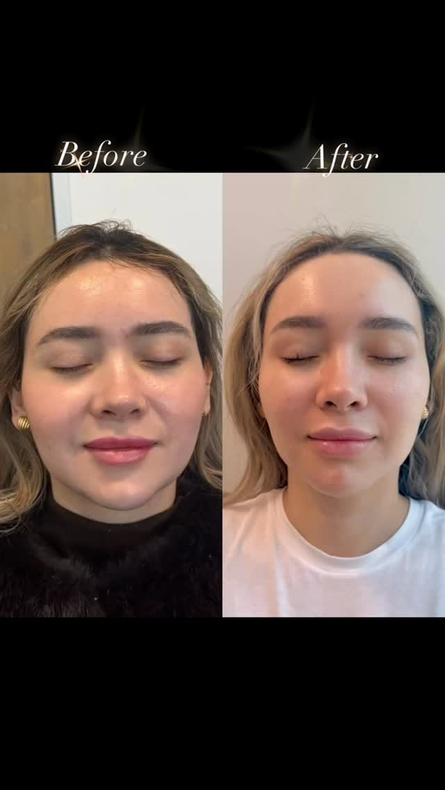 Post 2 by Paige Strahan, RN- DALLAS INJECTOR on Instagram (video)