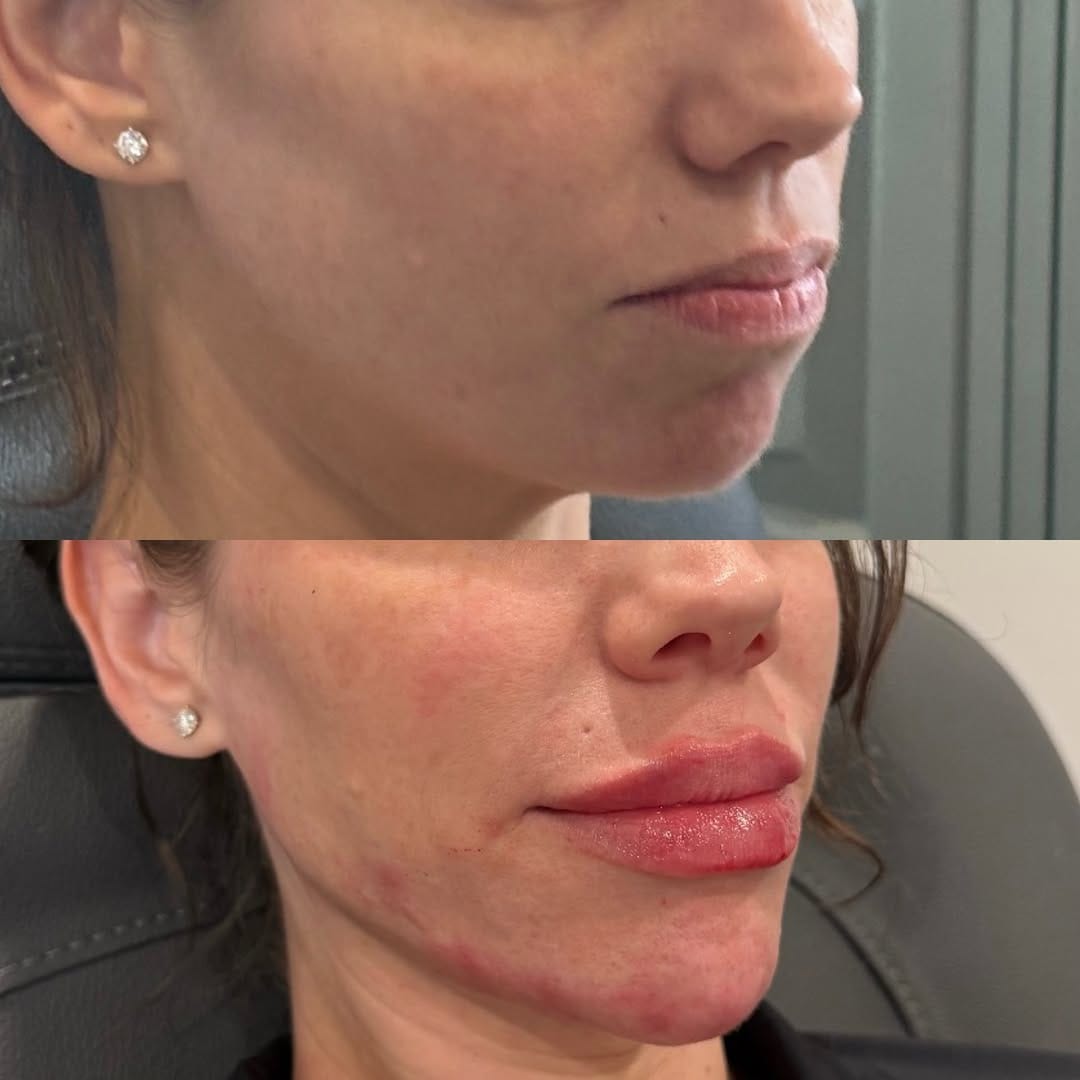 Post 1 by Paige Strahan, RN- DALLAS INJECTOR on Instagram (image)