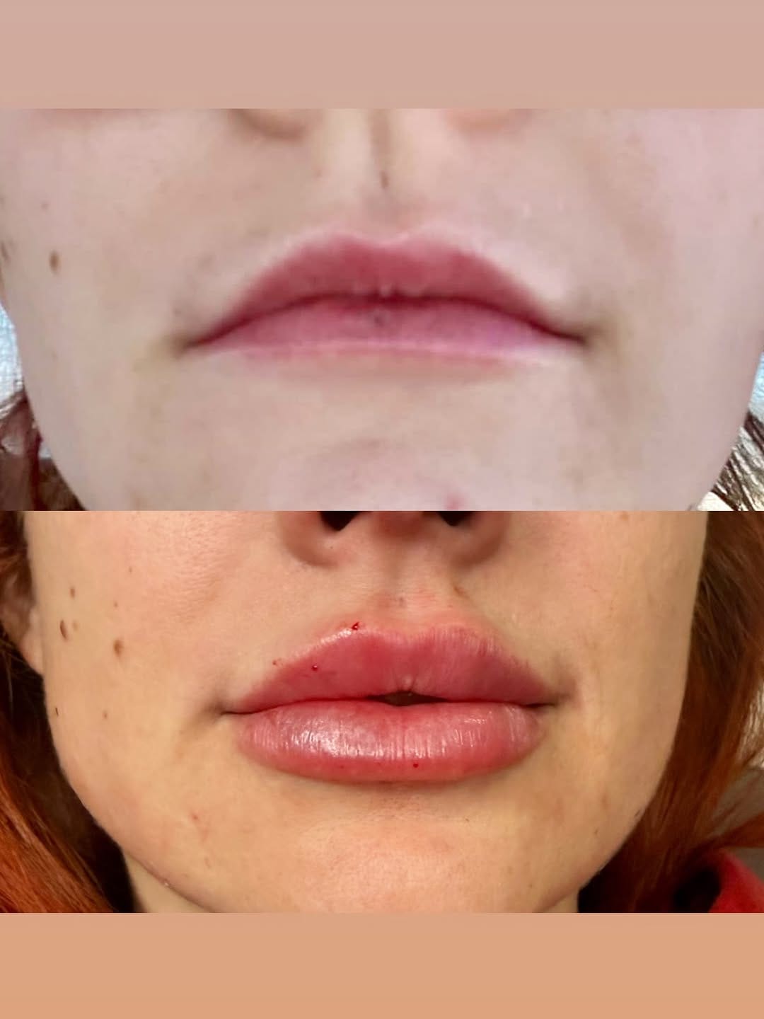 Post 3 by Paige Strahan, RN- DALLAS INJECTOR on Instagram (image)