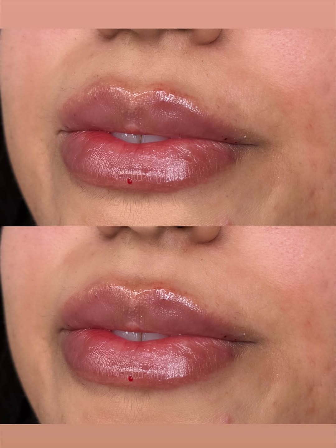 Post 7 by Paige Strahan, RN- DALLAS INJECTOR on Instagram (image)